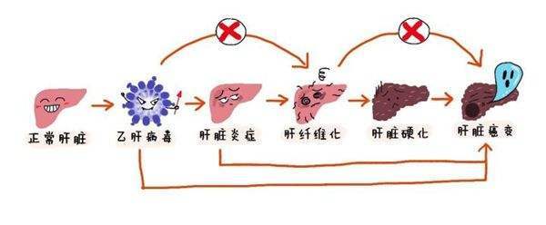 總以為乙肝病毒攜帶者無需治療,卻查出肝癌,只因這2個錯誤