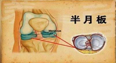 半月板損傷的症狀