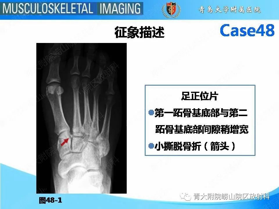 一文掌握|跖跗关节骨折脱位