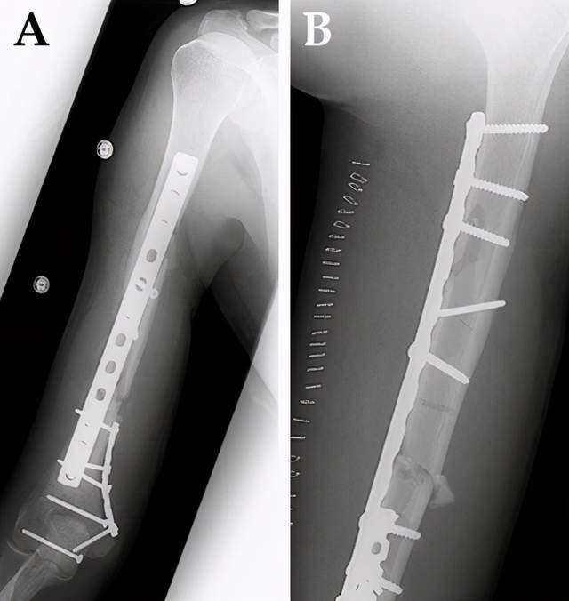骨折患者康复后钢板必须取出来医生辟谣教您根据病情来决定