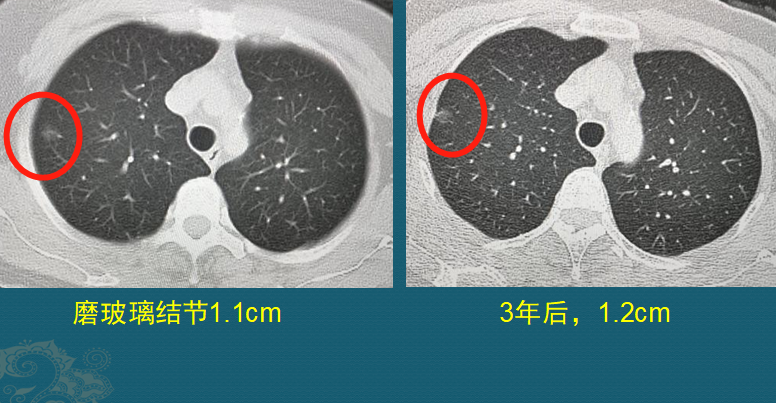 防癌要打时间差,看3个肺癌ct片,学会掐癌细胞脖子