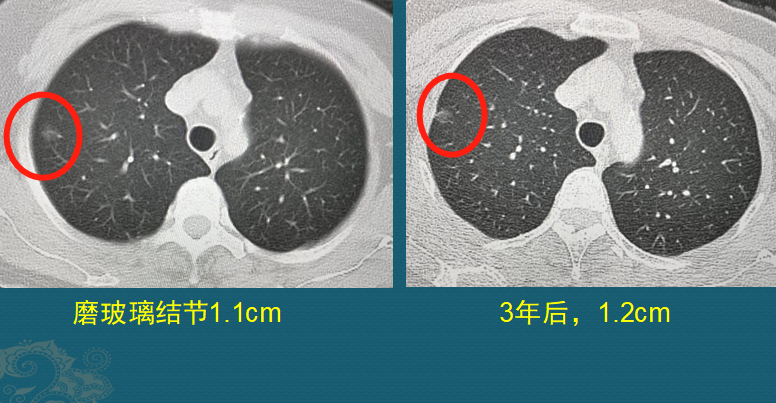 肺癌ct片图片