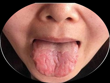 因恶性贫血可引起舌炎,舌萎缩,牛肉舌等辗转多个医院后才得以判定治疗