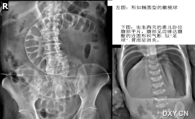 胃腸十大經典影像徵象 你都掌握了嗎