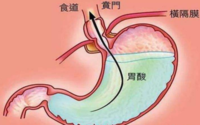 中医胃肠如何缓解胃酸过多中医分型辩证论治胃酸过多