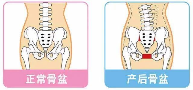 打无痛分娩产后会腰痛吗 腾讯新闻