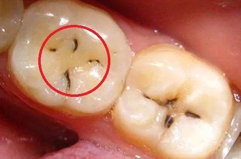 运气好的话,牙齿里面长这样 ▼▼▼▼▼