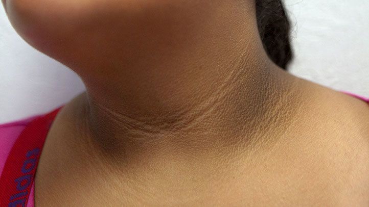 什么是2型糖尿病早期症状有哪些冬天血糖不易控医生告诉您