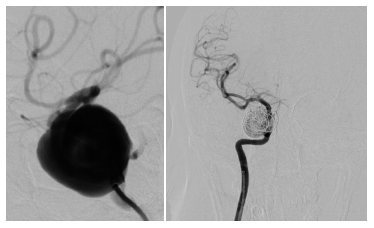 动脉瘤|五旬女子视力下降原来是动脉瘤，专家团队2mm伤口即可拆除颅内“炸弹”