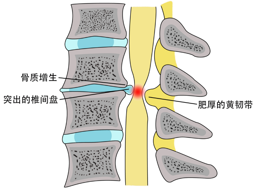 颈椎病的针刀治疗(第一课_腾讯新闻