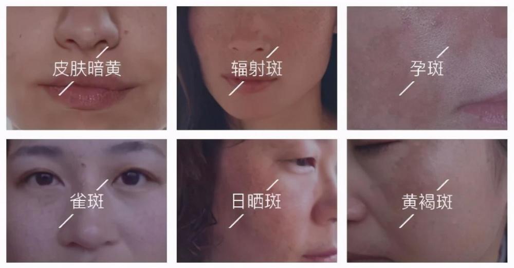 先了解你脸上的是什么斑!