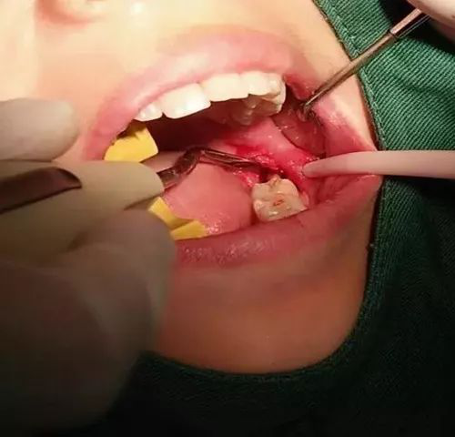 大连齿医生口腔科普 牙齿矫正需要拔牙?医生是这么回答的