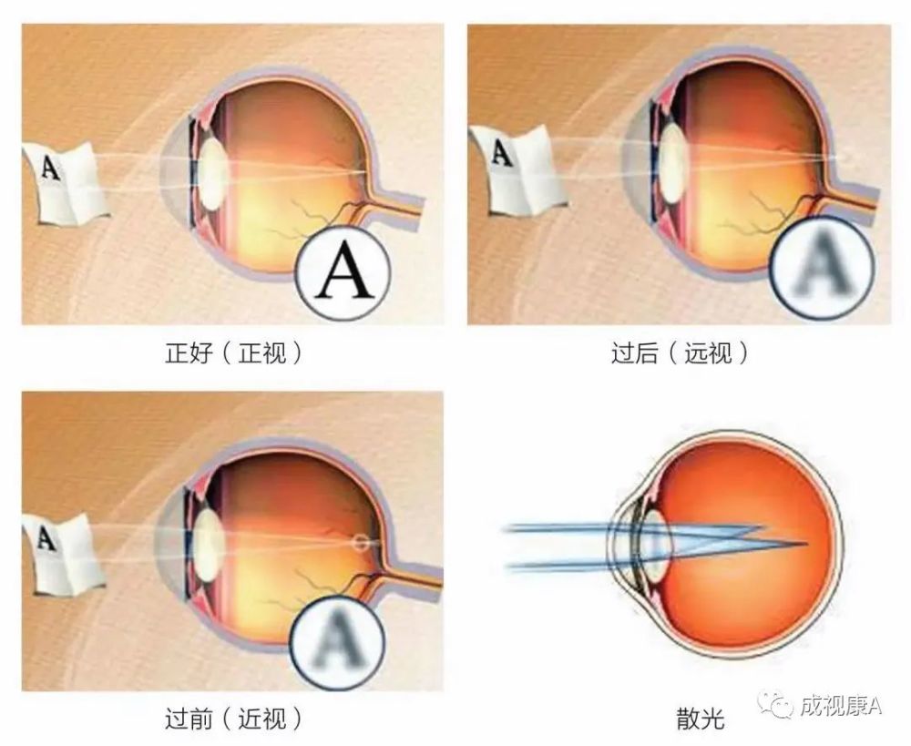 近视犹如癌症 腾讯新闻