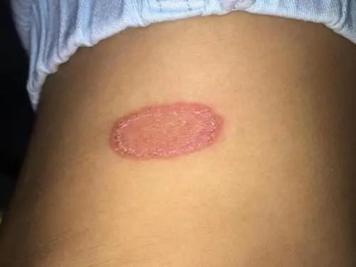 网友跟猫同吃同睡感染猫癣了怎么办