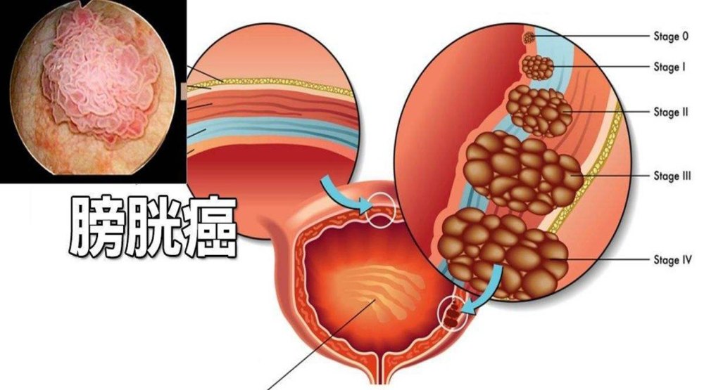 膀胱癌|北京膀胱癌牛小培专家：膀胱癌症状有哪些？