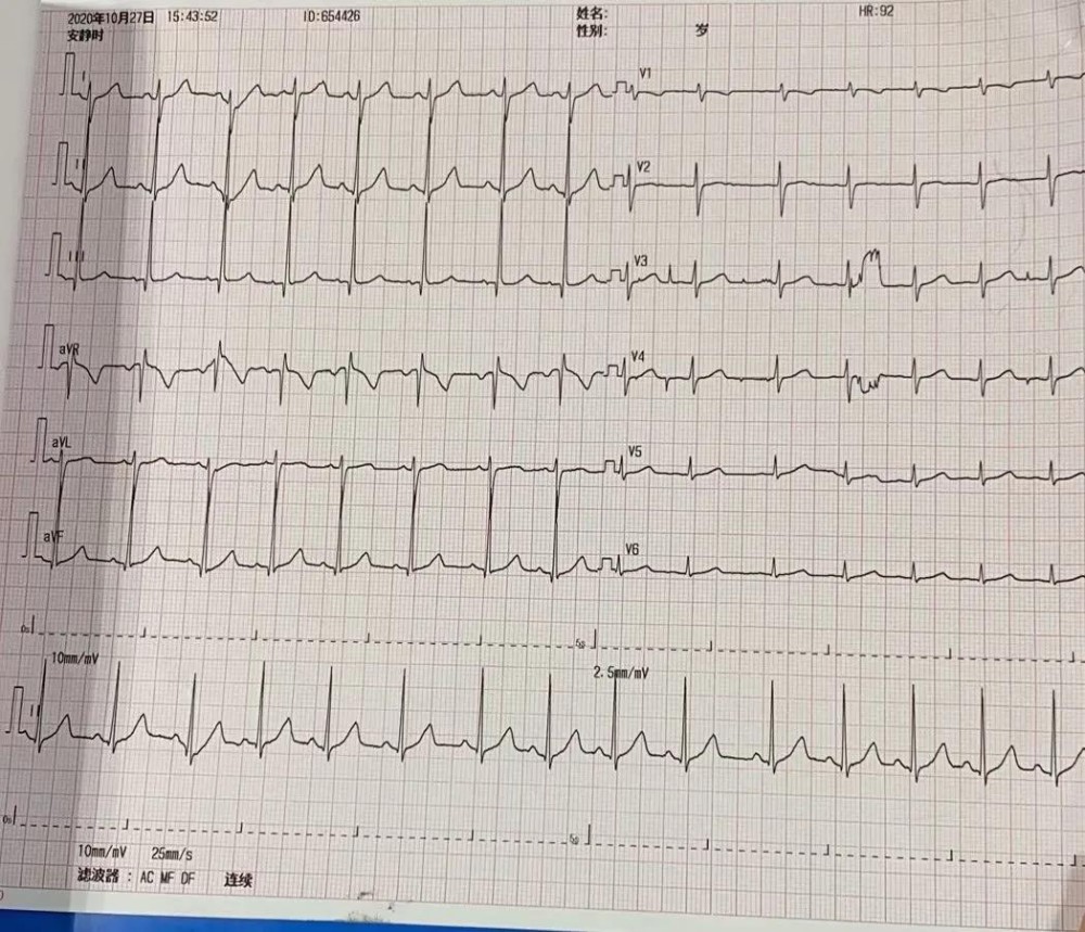 每分钟心跳200多次福建5岁男童患上这病