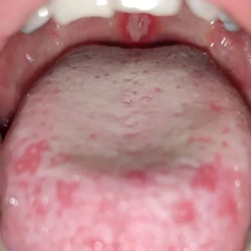 舌头上也能忍,腭垂上不能忍说实话,对于白塞病的诊断我是有疑虑的,加