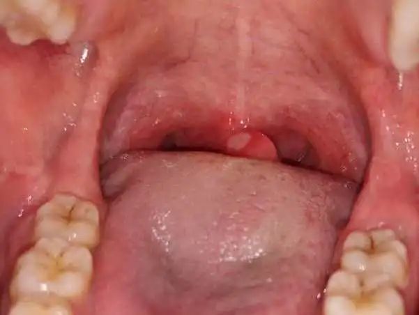 舌头上也能忍,腭垂上不能忍说实话,对于白塞病的诊断我是有疑虑的,加