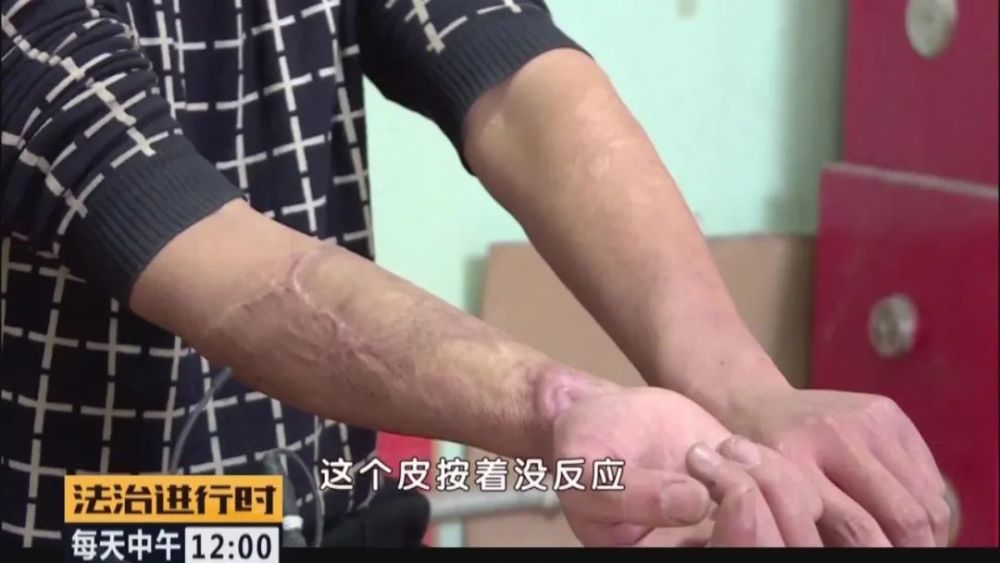 东城区|男子把滚烫的热油泼向同事，造成严重伤害后无力赔偿