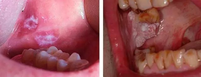 为什么有人总是得口腔溃疡,而有些人从来都不会"口舌生疮"呢?