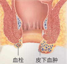 正確認識外痔很重要!