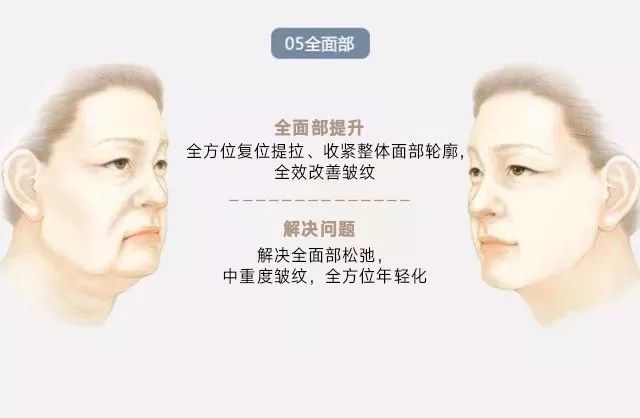 加减美|北京加减美面部年轻化V美减龄技术怎么样？