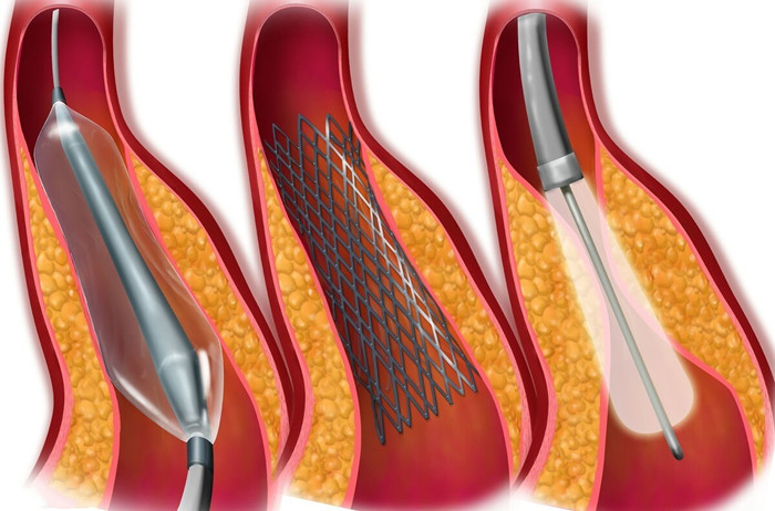 血压高|心肌梗死最好的治疗方法是什么？需要用到哪些药物才能救命！