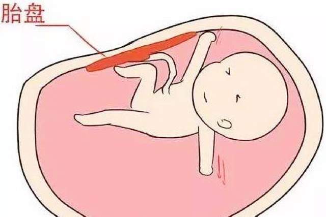 孕期长期仰卧睡居然睡成了胎盘早剥睡姿真的不是小事