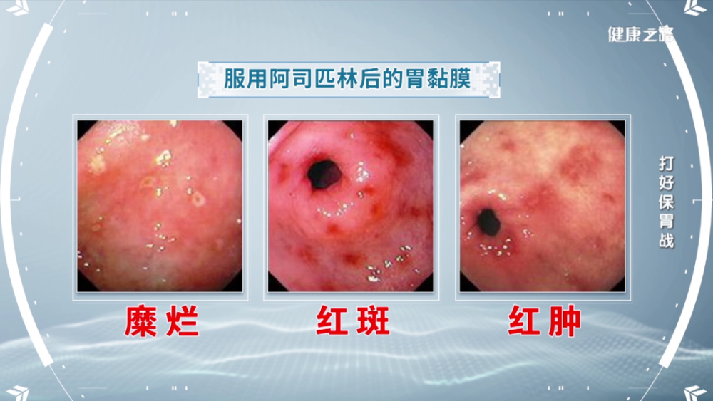 胃穿孔很可怕!日常生活要注意!|健康之路