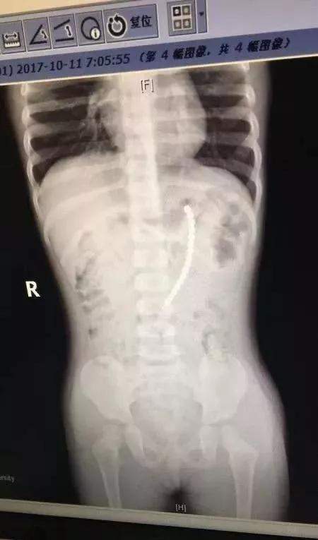 上海|福建3岁女孩被玩具直插颅脑！这些玩具危险重重，你家至少有一样！