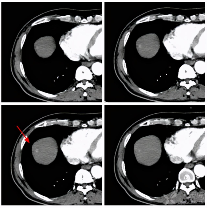 8种最要命的癌症 普通的早筛体检能查出来吗 腾讯新闻