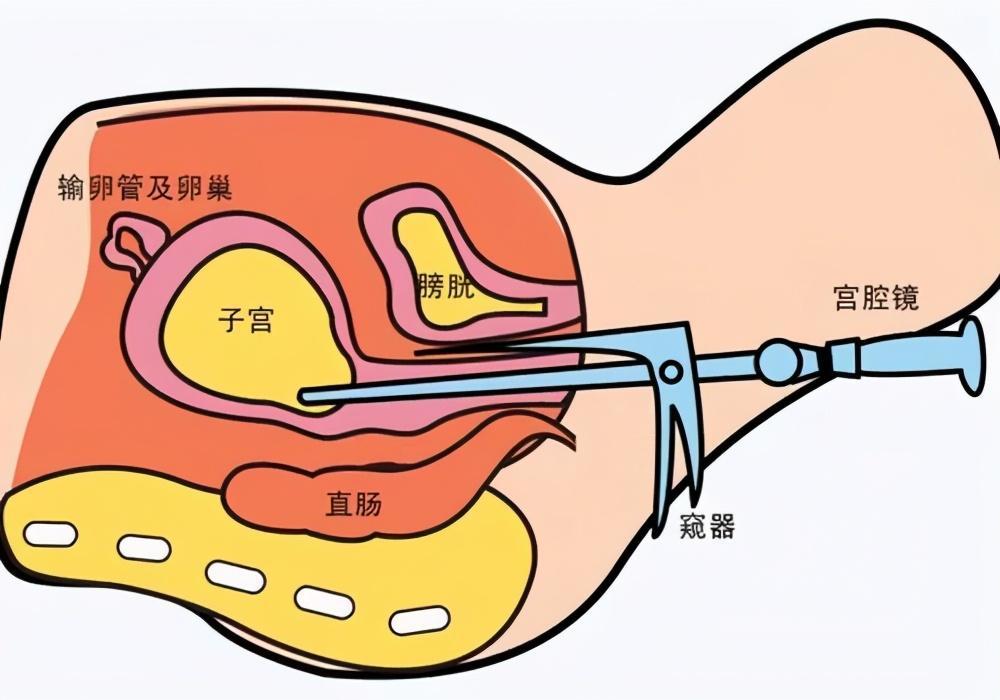 有子宫内膜息肉怎么做试管移植(子宫内膜有息肉可以做试管移植吗)-第2张图片-鲸幼网