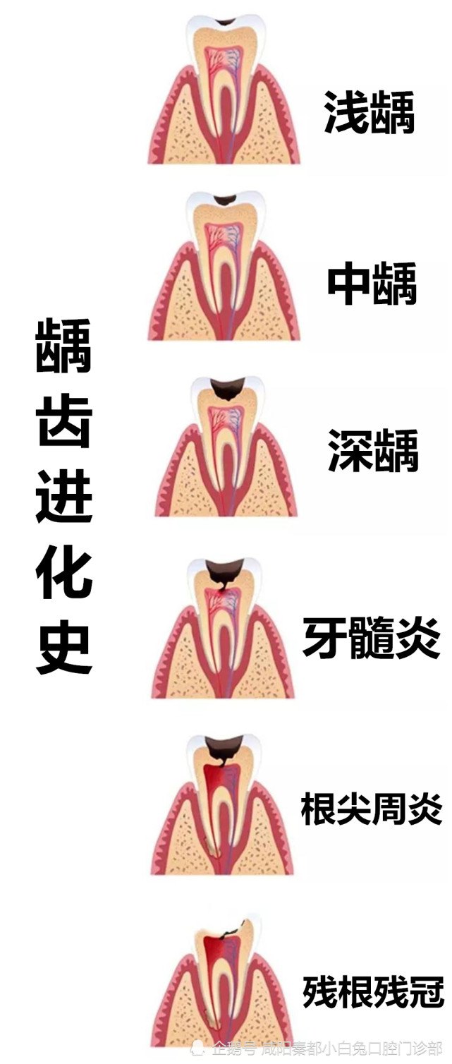 如何做好龋齿的预防呢