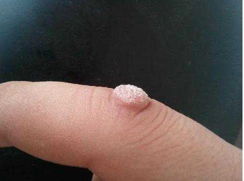 女人哪个地方长"疙瘩",说明身体感染了hpv?
