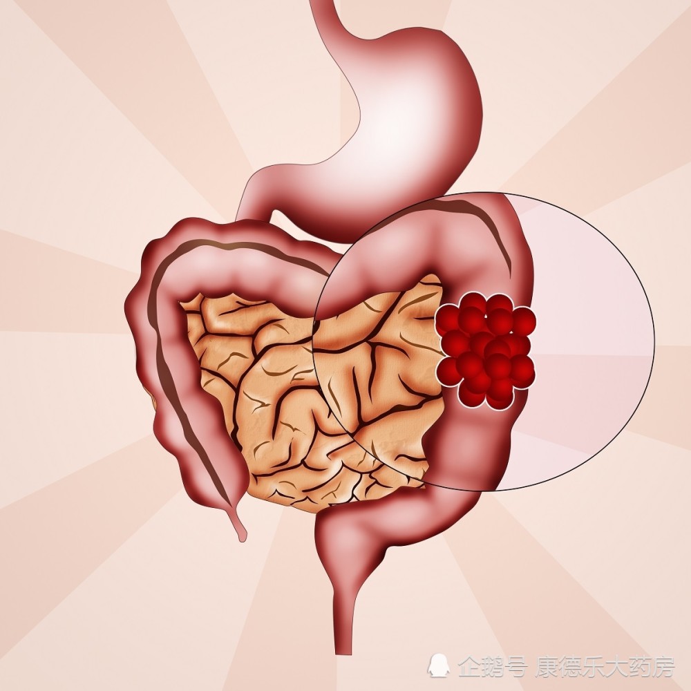 瞭解結腸癌的病因做好對應的預防措施