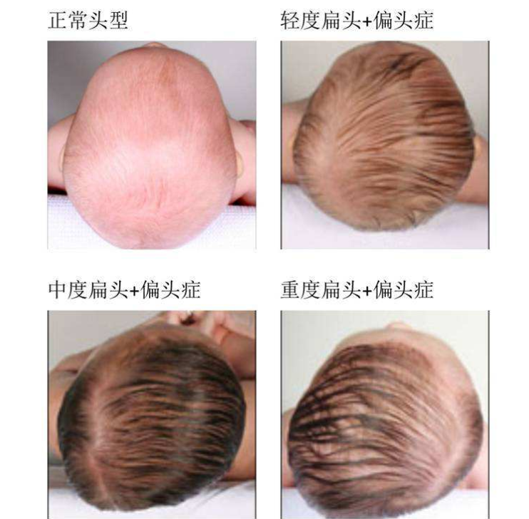 为啥老一辈非要让宝宝"睡扁头"?过来人:长大后很毁孩子颜值