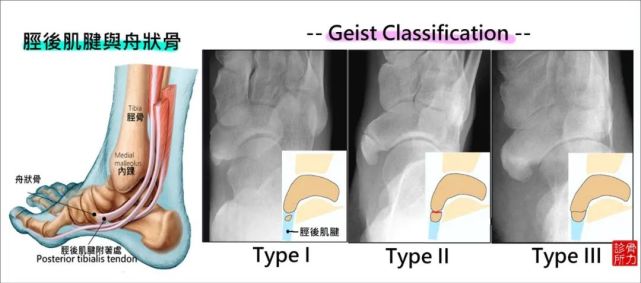 运动康复 慢性内踝疼痛 副舟状骨症候群 腾讯网