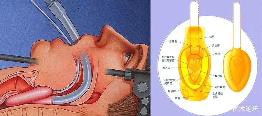 被忽略的困难气道 腾讯新闻