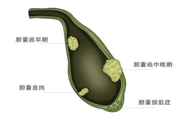 胆囊癌并非没有信号 医生 身体频繁出现3个异常 多是胆囊病变 腾讯新闻