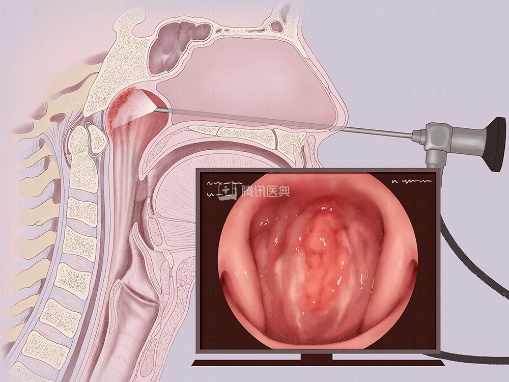 鼻咽隐窝图片