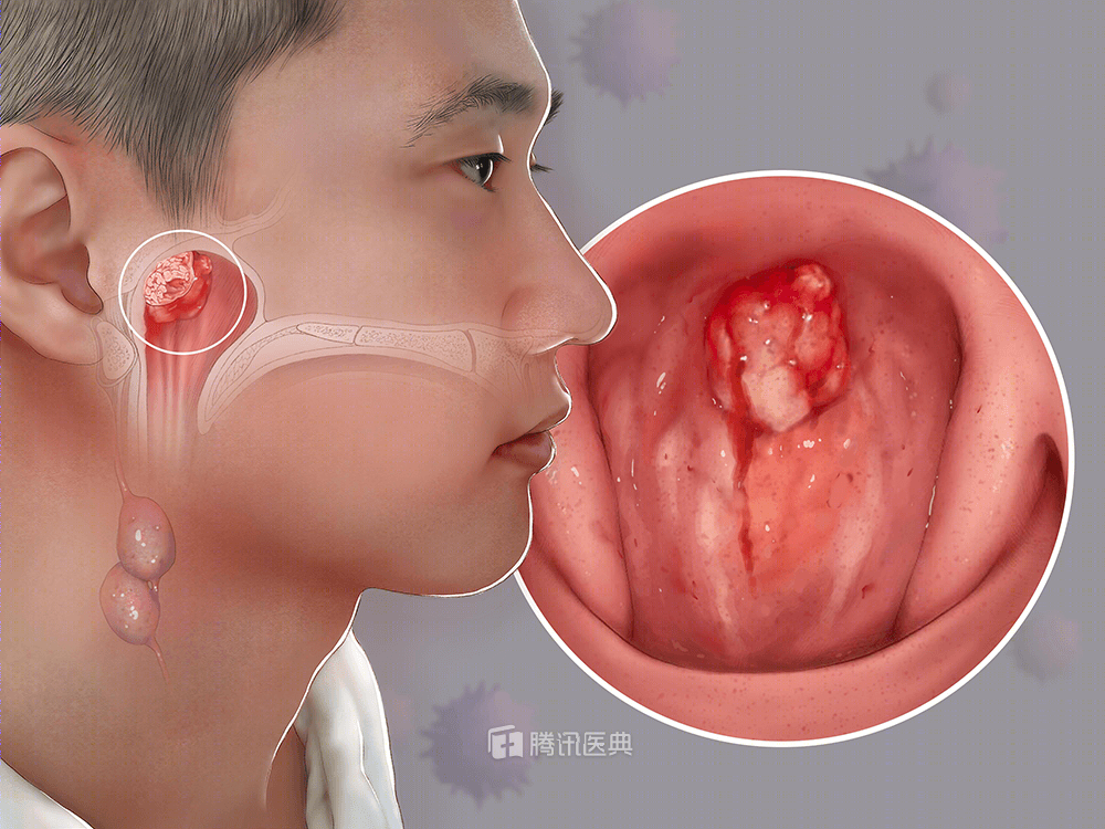 鼻咽癌(nasopharyngeal cancer,npc)广义上是指发生于鼻咽腔顶部和侧