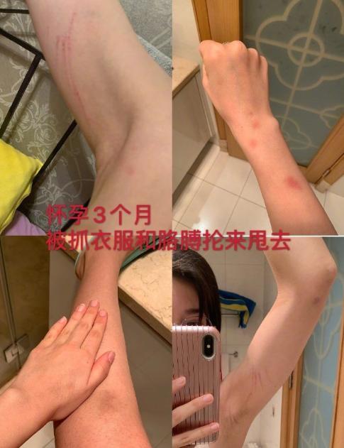 张漠寒|张培萌妻子首谈家暴细节：产后17天被暴打，3次报警都无疾而终