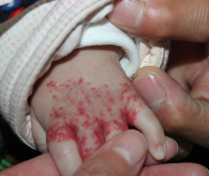 孩子手部血管瘤是怎么一回事?