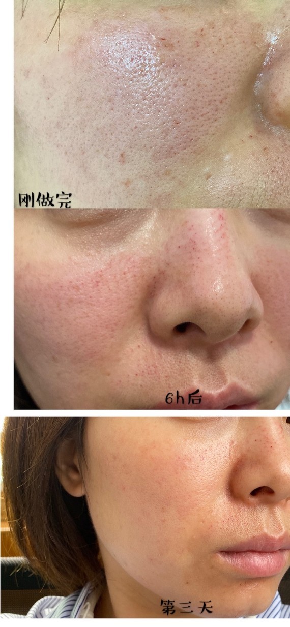 毛孔粗大做医美多少钱_毛孔粗大做医美多少钱一次