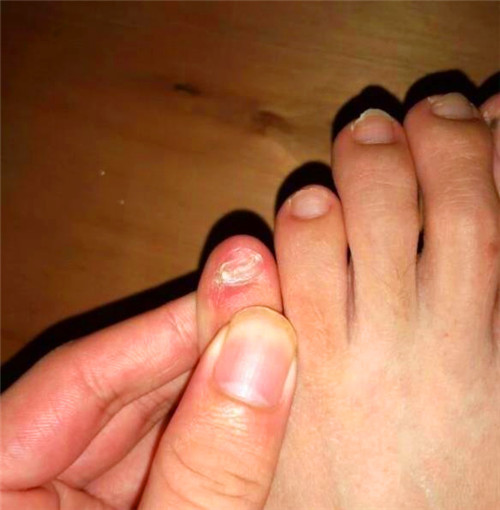 这种小脚趾复趾的情况在东亚是非常常见的,尤其是在汉人里面出现的