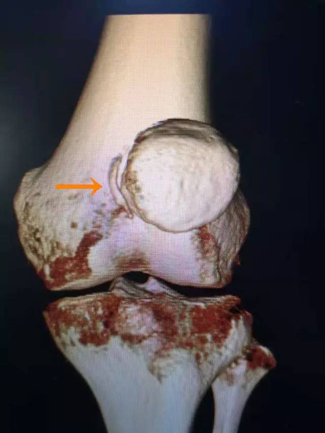 谈"骨"论"筋" |髌骨脱位偏爱花季少女?