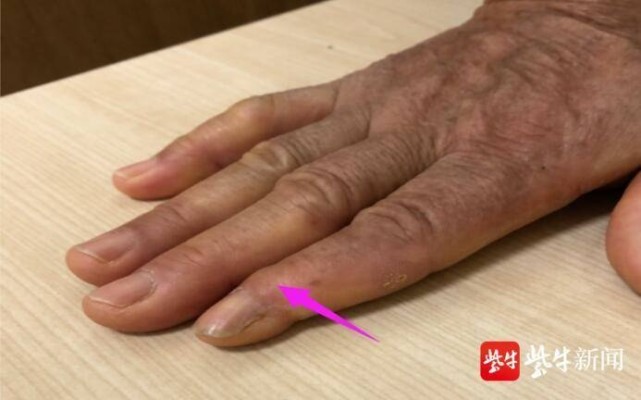 1个月前她曾被流浪猫挠伤|腋下|猫抓病|淋巴结肿大|常州三院|淋巴结肿