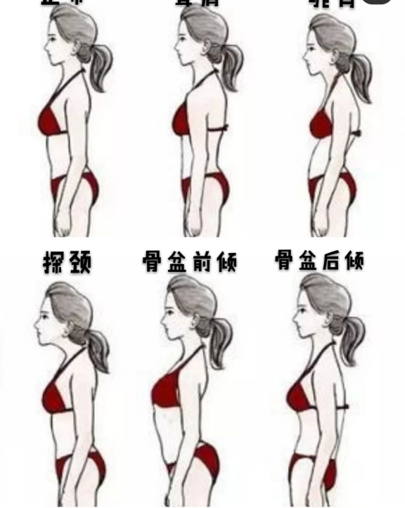 第二种是耸肩,第三种是驼背,第四种是探颈也就是我们常说的脖子前倾