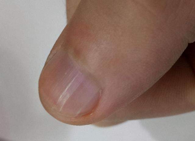 肝脏不好的人指甲有4种变化若一个不占肝脏还算健康