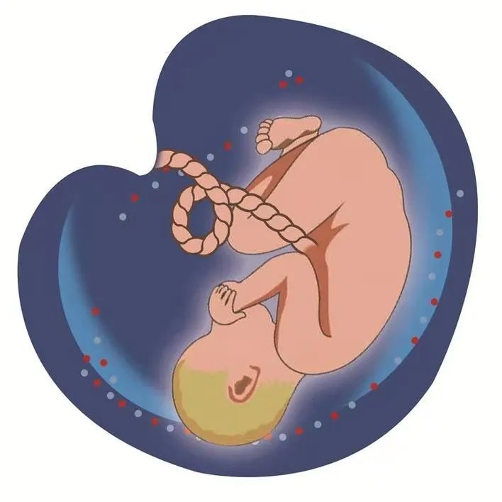 脐带扭转45圈8个月胎宝惊险逃生